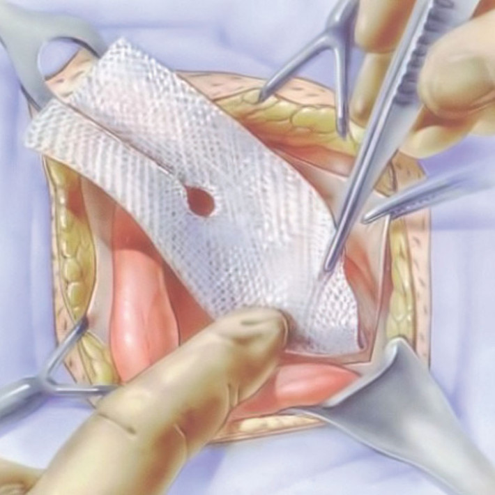 Plasa chirurgicala, toate tipurile de hernii si eventratii, ochiuri mici, dreptunghiulara, polipropilena, 30x30cm, sterila